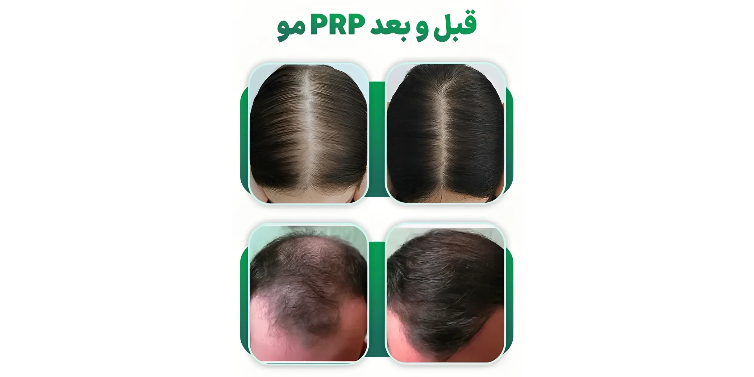 روش پی ار پی برای ریزش مو