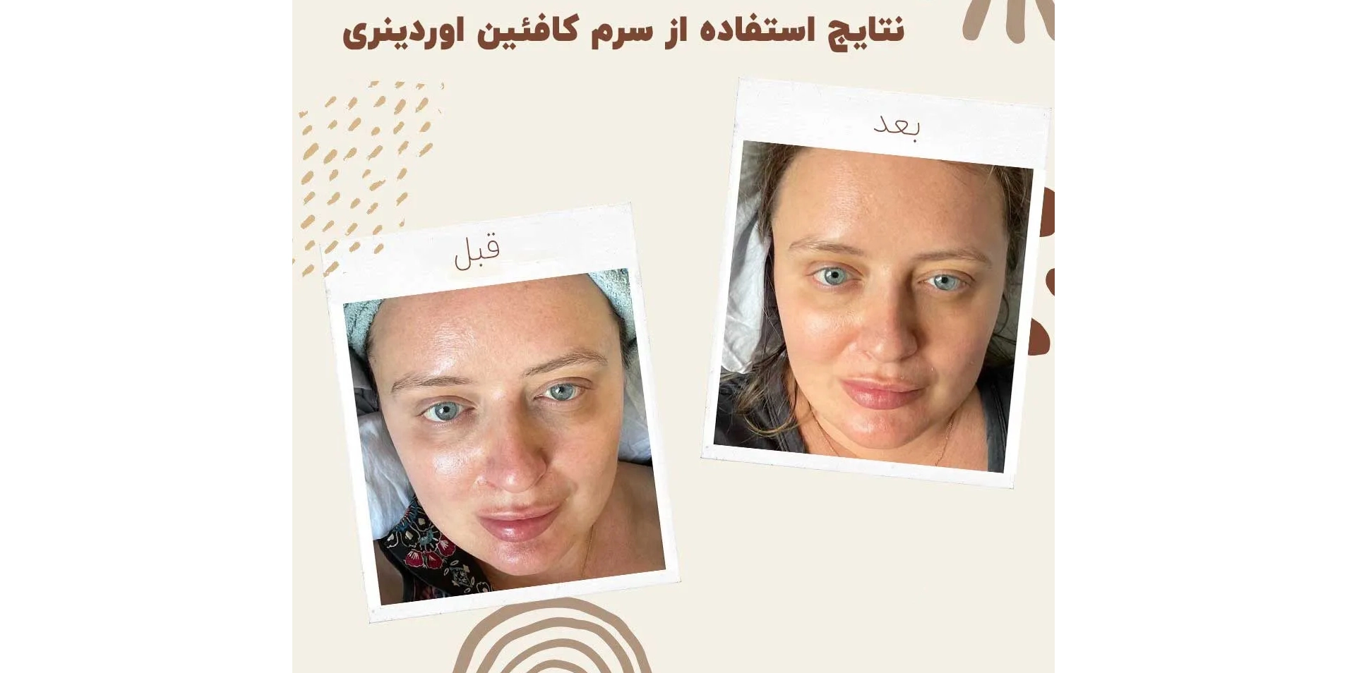 سرم کافئین اوردینری