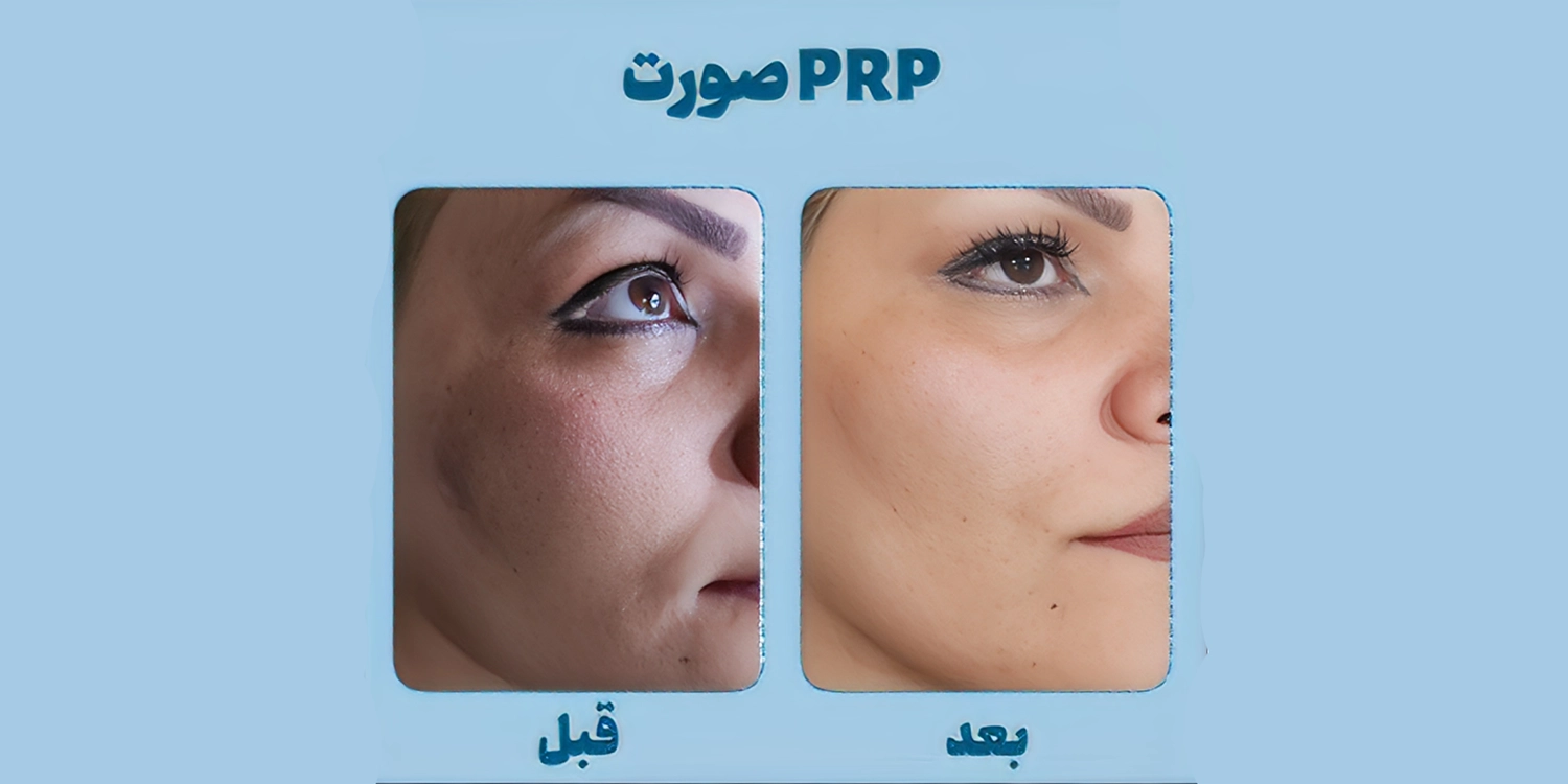 ایا پی ار پی صورت را چاق میکند