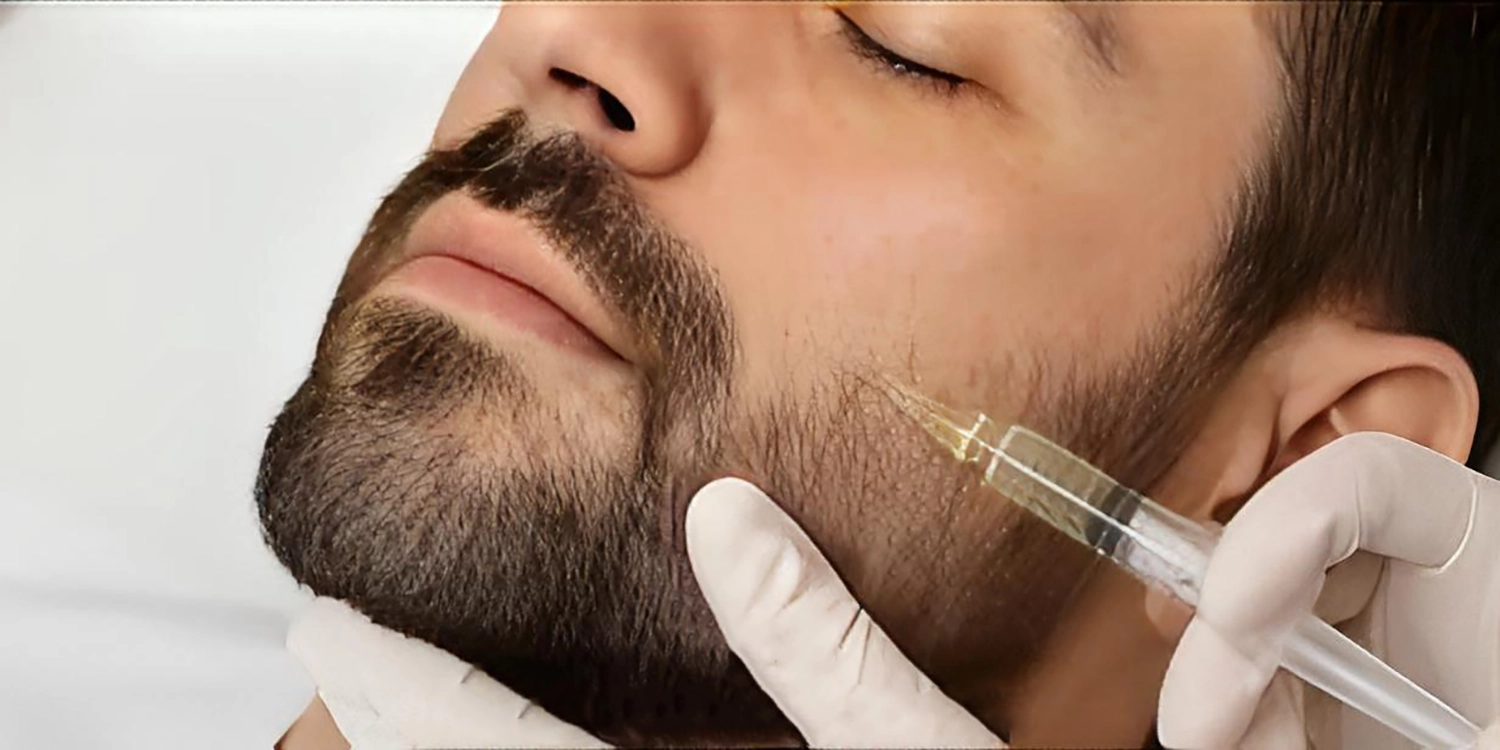  راهنمای کامل مزوتراپی برای ریش و سبیل